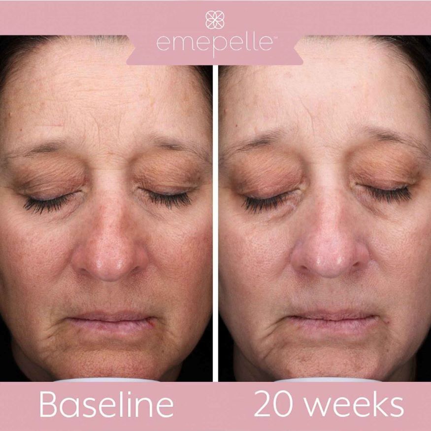 Emepelle Serum 35ml - Improves Visible Signs of Ageing Caused by Menopause