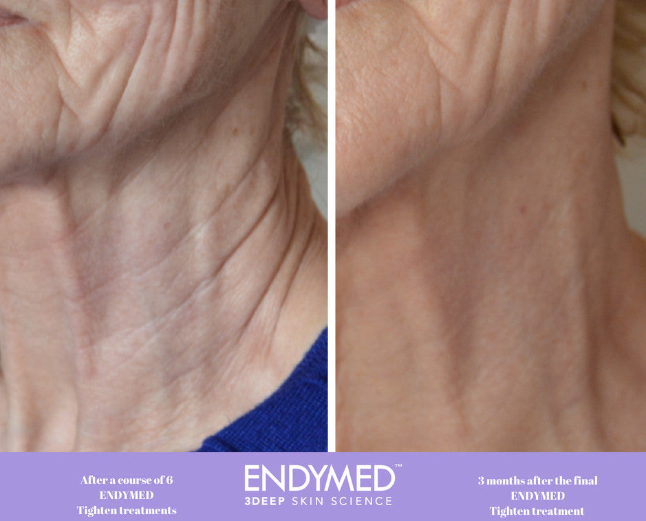 Radio Frequency Skin Tightening Eye | Brains Street