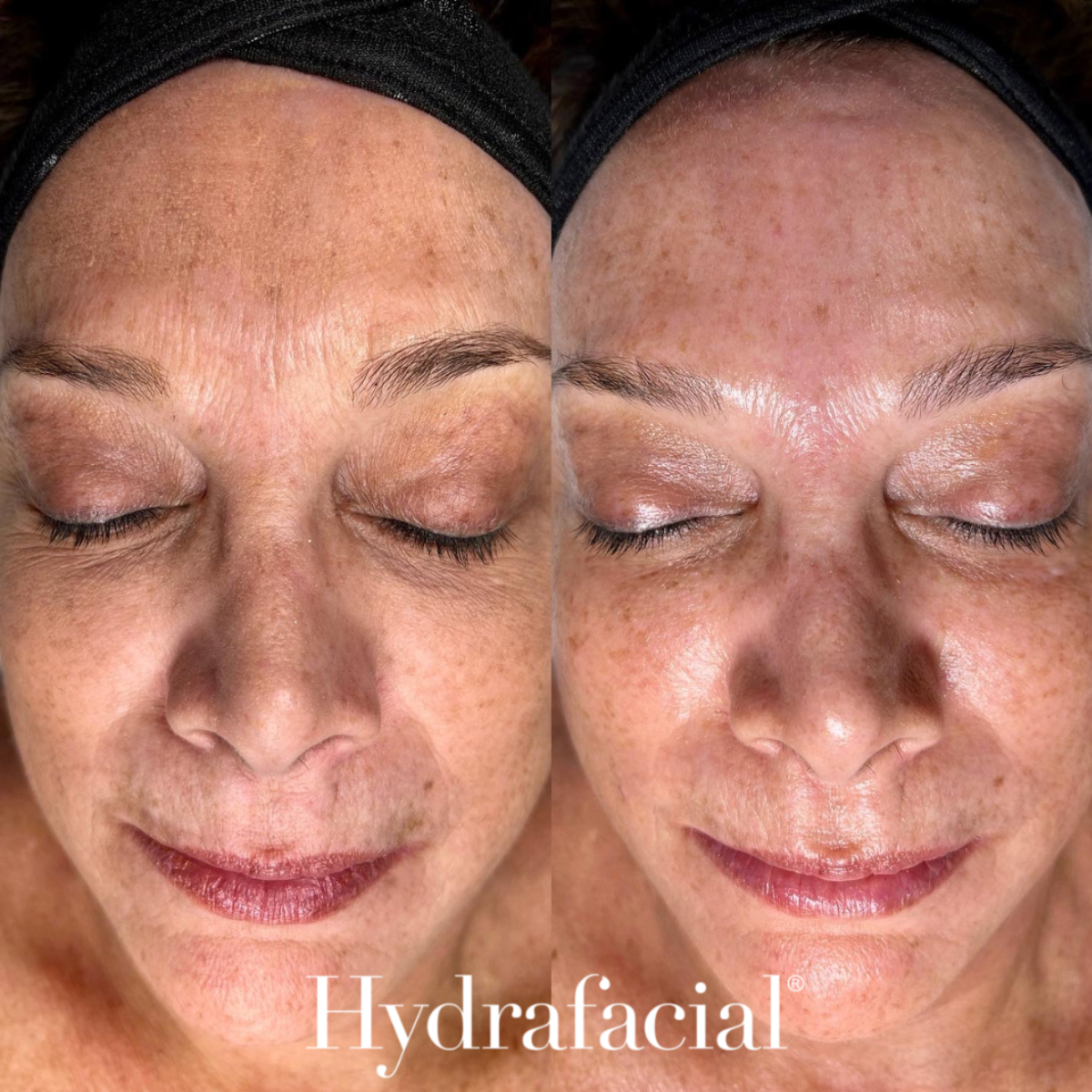 Signature Hydrafacial Skin Treatment - 45 mins | Brains Street