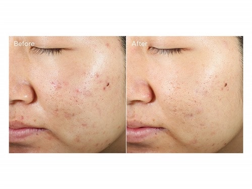 Invisiscar Resurfacing Treatment 15ml