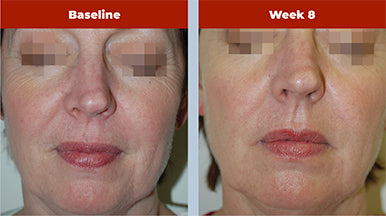 Retriderm Serum Max - Powerful 1% Retinol