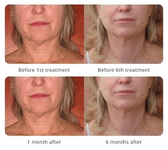 Radio Frequency Skin Tightening Eye | Brains Street