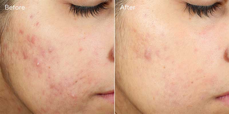 Invisiscar Resurfacing Treatment 15ml
