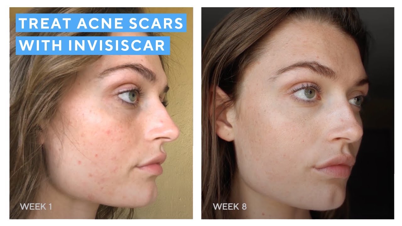 Invisiscar Resurfacing Treatment 15ml