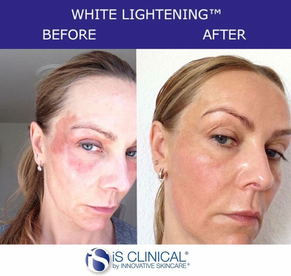White Lightening Serum | Brains Street
