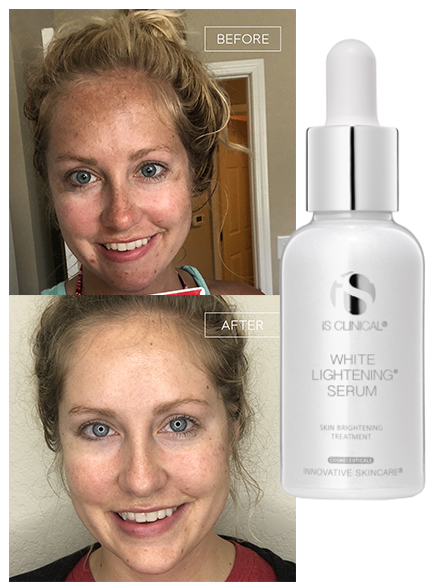 White Lightening Serum | Brains Street